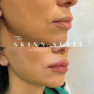 Lip filler before and after to restore volume and hydration.