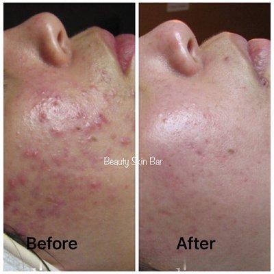 Acne Treatment