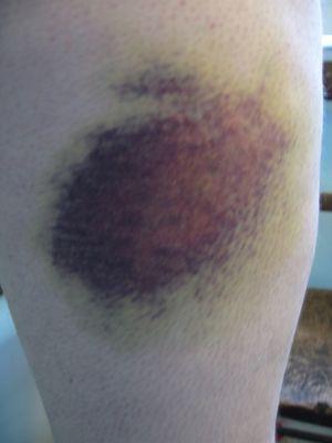 Here is a photo of what my arm looked liked when they first bruised my arm.