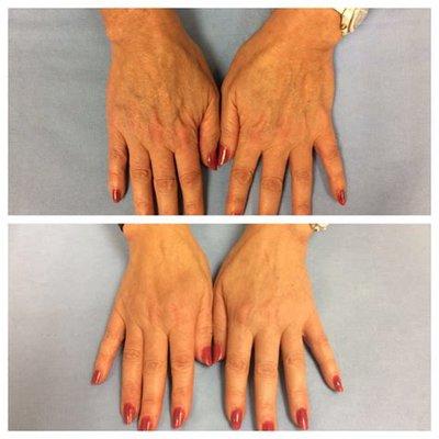 New treatment for aging hands. Filler is used to restore volume!