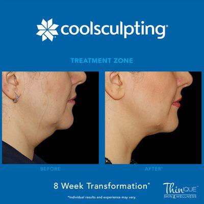 Buy 3 treatments get 1 free!
 
 Eliminate stubborn chin fat!