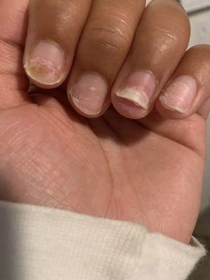 Fungus infected and ate away my nails