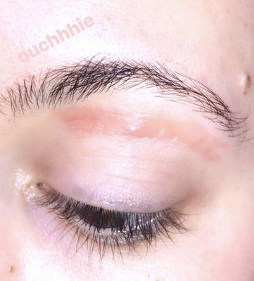 Burn from eyebrow wax