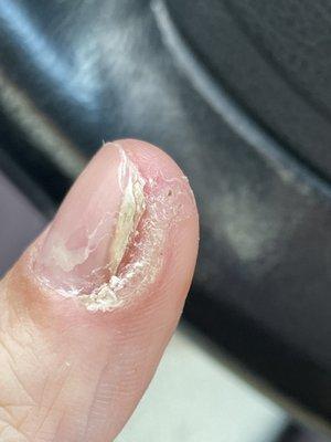 Fingernail Fungus, Plantar Warts