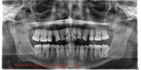 X-Ray taken by  REAL Orthodontist who told me that she would not touch me without my first seeing a surgeon for an opinion.