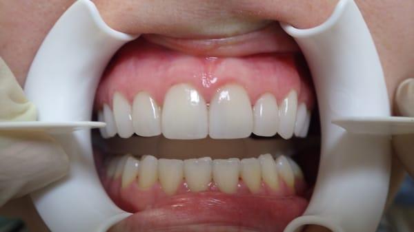 Porcelain Veneers after 2