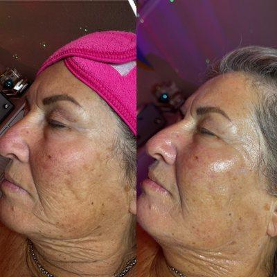 Before & after Glow on Main facial