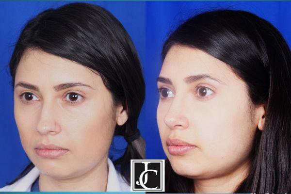 Rhinoplasty by Dr Jay Calvert