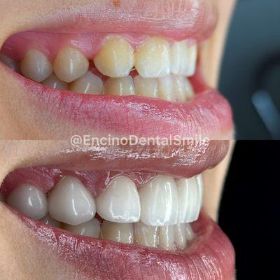 Upper natural smile makeover with gum lift