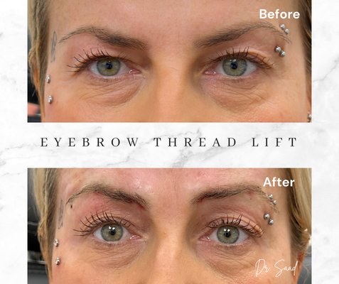 Thread lifting of Eyebrows