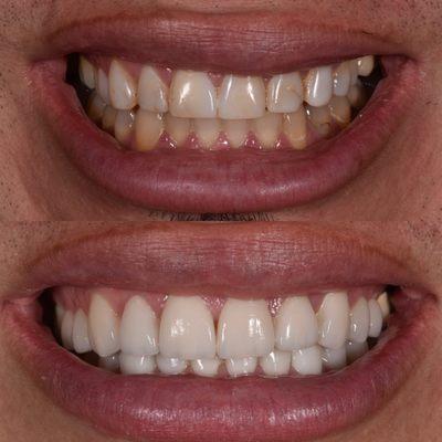 Top and Bottom Natural Design Veneers