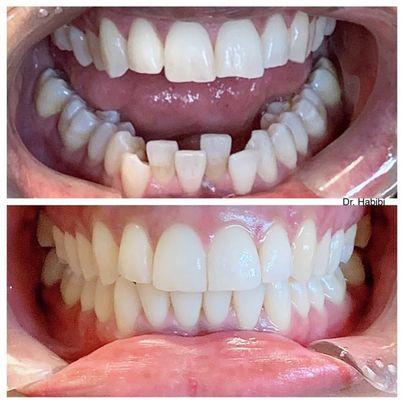 Before and after Invisalign treatment