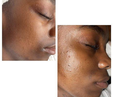 Dermaplaning