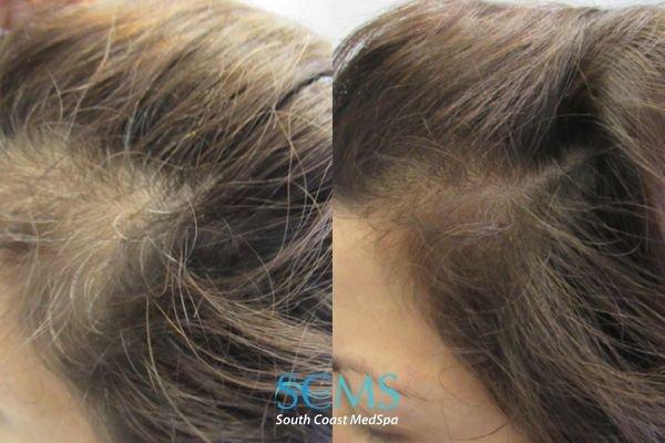 Before and After Platelet-Rich Plasma for Hair Restoration at SCMS