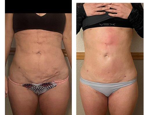 4-6 Radio Frequency and cavitation and laser pads. To smooth scars and sculpt her shape .