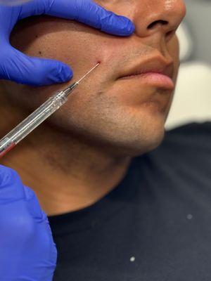 Nasoloabial Dermal Filler