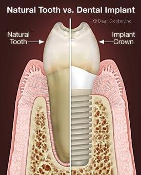 Implants can restore your mouth and appear completely natural