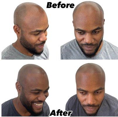 thinning hair, receding hairlines, or even complete hair loss