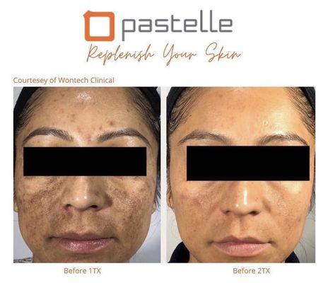 Laser skin carbon peel