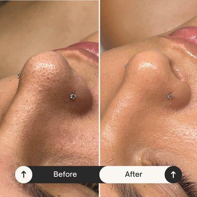 Blackhead extractions