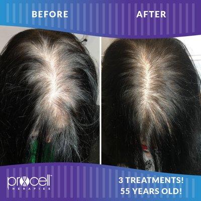 Procell Microchanneling Hair Restoration