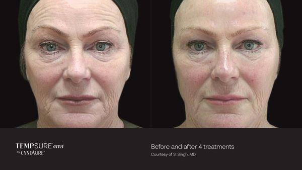 Check out these stunning results from our TempSure treatment!