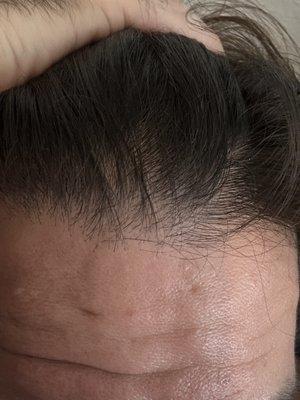 Crown hairline thinning from predatory for profit TRT business practices.