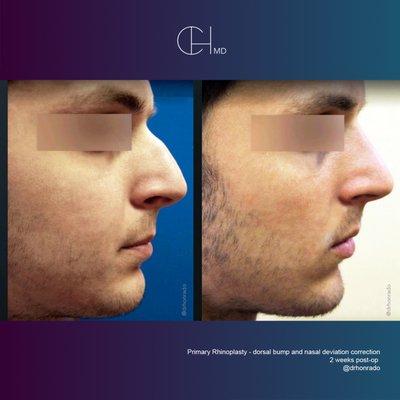 Carlo Honrado, M.D., F.A.C.S.- Primary Rhinoplasty & Septoplasty (dorsal bump and nasal deviation correction) patient 2 weeks post-op