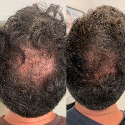 Before and after PRP with Acell and topical Dutasteride solution.