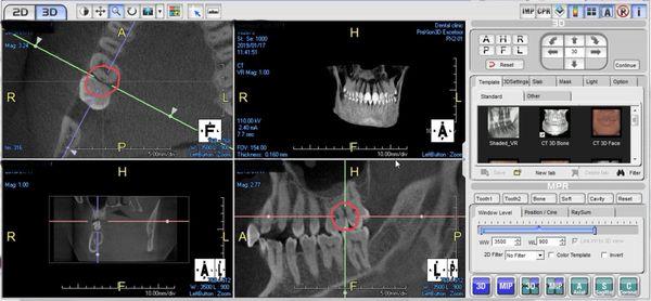 Our 3D X Ray scanner picked up decay when traditional  2D bitewing X Rays did not show the decay.