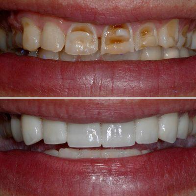 8 upper porcelain veneers...such a dramatic change