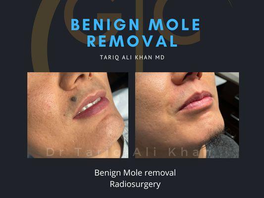 Radiosurgical Mole Removal + Laser Hair removal for terminal hairs - Dr Tariq Khan