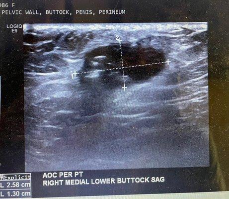 Mass found after nurse practitioner Jackie shamed me for requesting approval for buttock ultra sound