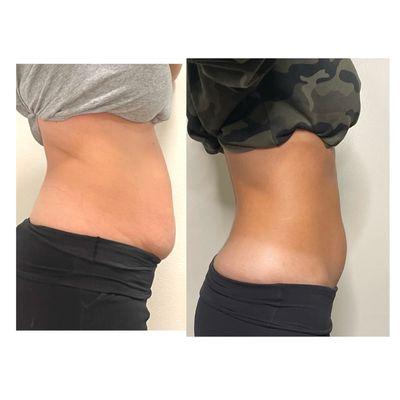 Non-invasive Lipo Cavitaton. Target and mely away Stubburn fat deposits