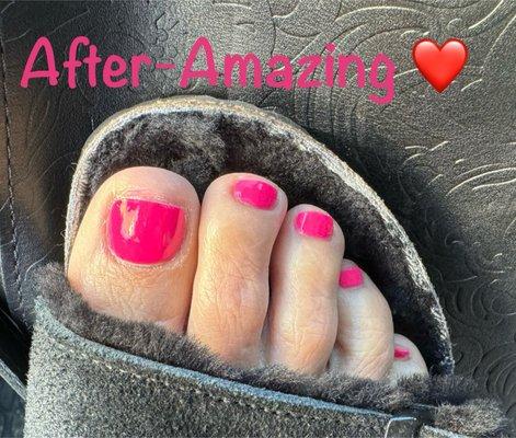 After amazing!  Love my toes again!