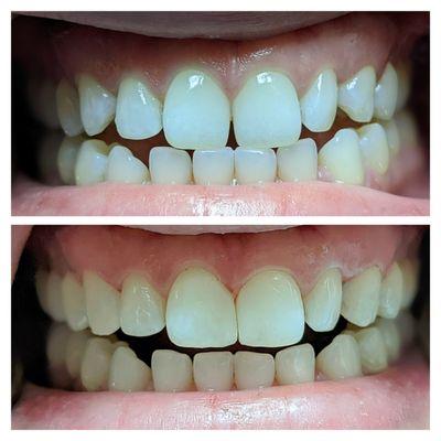 Added composite to close spaces and blend naturally with the patient's tooth. No numbing or drilling was required.