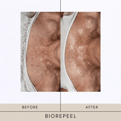 BioRePeel | chemical peel | Balance Lab Aesthetics