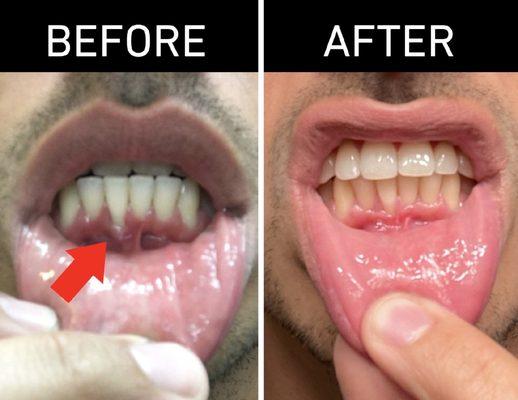 Gum grafting before and after. Gum was separated from tooth in before photo.