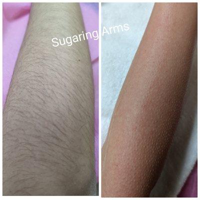 Arms Sugaring