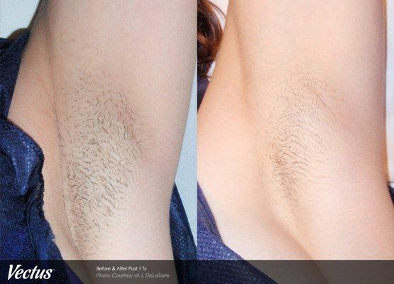 Laser Hair Removal