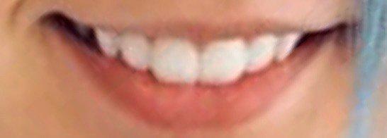 My teeth before seeing Chen July 2021