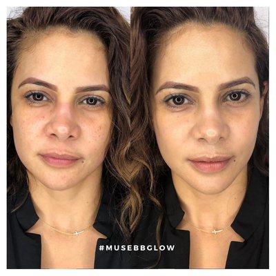 before and after the bbglow treatment