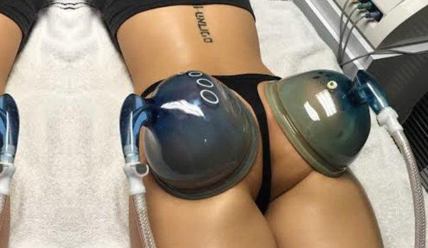 Buttock Therapy, non invasive alternative to Brazilian butt lift