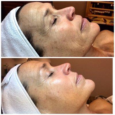 Before and after - four weeks of LED and Microcurrent treatments