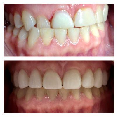 Smile makeover by Dr. Miriam Kerman