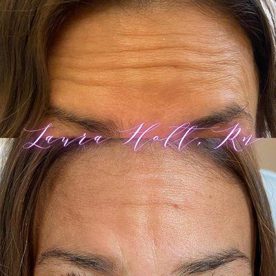 Tox Injections to Forehead