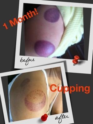 Cupping is one of the oldest methods of traditional Chinese medicine. Glass cups are warmed using a cotton ball.