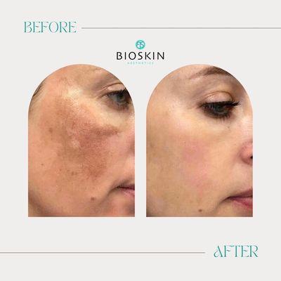 BioRePeel before and after hyperpigmentation