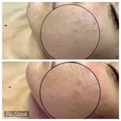 Purifying, Acne facial... black head & white head removal