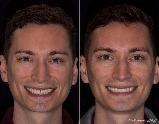 Before and after porcelain veneers